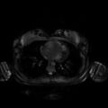 Normal MRI abdomen in pregnancy (Radiopaedia 88001-104541 D 1).jpg