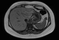 Normal liver MRI with Gadolinium (Radiopaedia 58913-66163 B 24).jpg