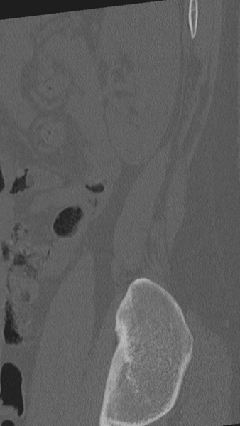 File:Normal lumbar spine CT (Radiopaedia 46533-50986 Sagittal bone window 6).png