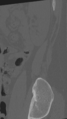 Normal lumbar spine CT (Radiopaedia 46533-50986 Sagittal bone window 6).png