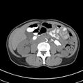 Normal multiphase CT liver (Radiopaedia 38026-39996 Axial non-contrast 42).jpg