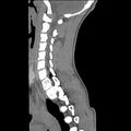 Normal trauma spine imaging (age 16) (Radiopaedia 45335-49358 C 25).jpg