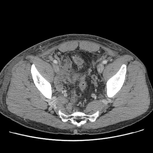 File:Obstructive bladder transitional cell carcinoma (Radiopaedia 9825-10410 A 28).jpg