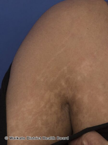 File:Postinflammatory hypopigmentation after recovery from dengue-like rash in a patient with suspected COVID19. (DermNet NZ covid-postinflammatory-008).jpg