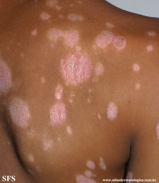 File:Psoriasis (Dermatology Atlas 88).jpg