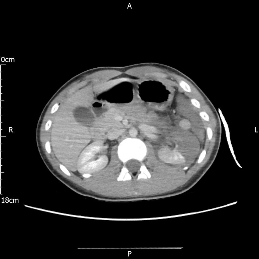 AAST grade IV kidney injury with CEUS follow-up (Radiopaedia 72353-82877 Axial C+ portal venous phase 24).jpg