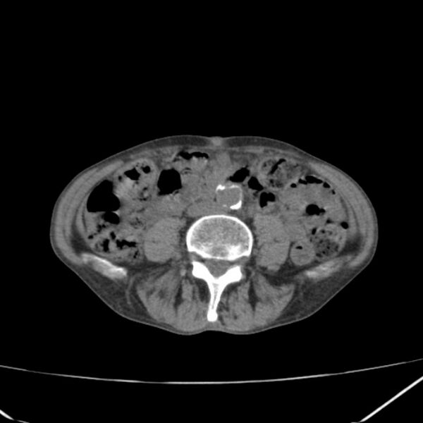 File:Abdominal aortic aneurysm (Radiopaedia 23703-23856 Axial non-contrast 32).jpg