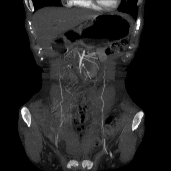 File:Abdominal aortic aneurysm (Radiopaedia 23703-23856 Coronal C+ arterial phase 2).jpg
