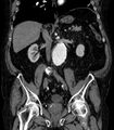 Abdominal aortic aneurysm (Radiopaedia 25855-26001 Coronal C+ arterial phase 37).jpg