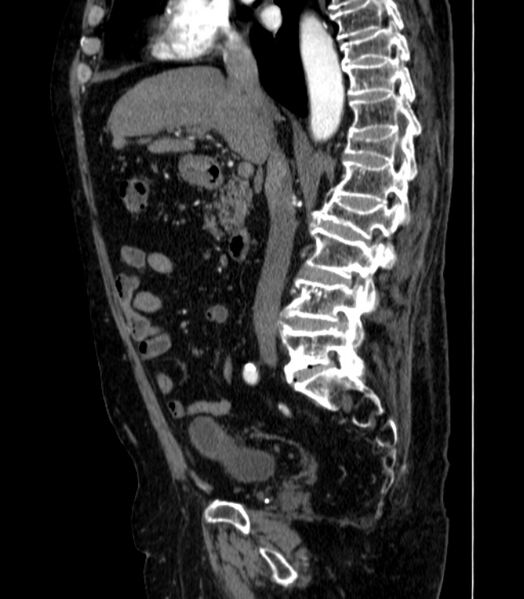 File:Abdominal aortic aneurysm (Radiopaedia 25855-26001 Sagittal C+ arterial phase 17).jpg