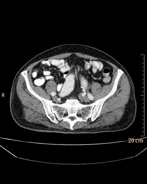 File:Abdominal aortic aneurysm (Radiopaedia 25985-26121 Axial C+ arterial phase 33).jpg