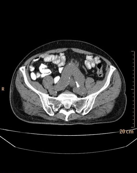 File:Abdominal aortic aneurysm (Radiopaedia 25985-26121 Axial non-contrast 23).jpg