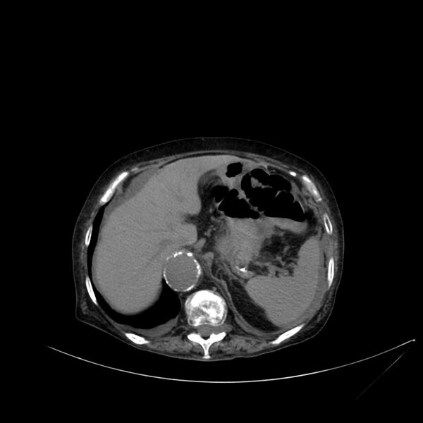 File:Abdominal aortic aneurysm - impending rupture (Radiopaedia 19233-19246 Axial non-contrast 29).jpg