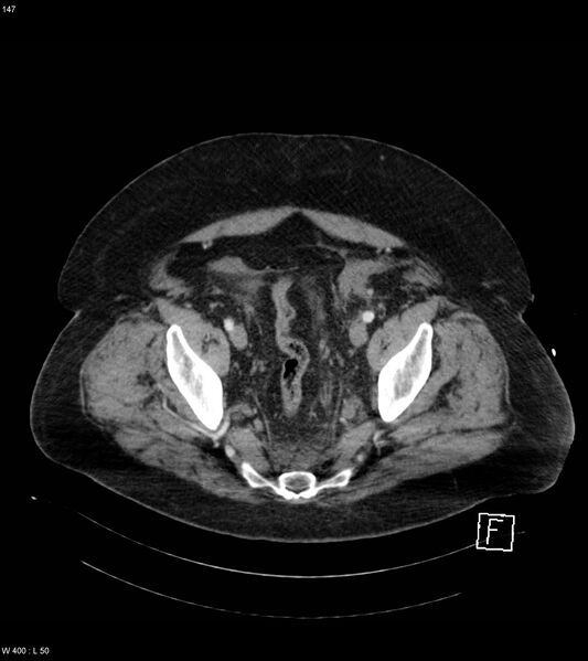 File:Abdominal aortic aneurysm with intramural hematoma then rupture (Radiopaedia 50278-55632 Axial C+ arterial phase 146).jpg