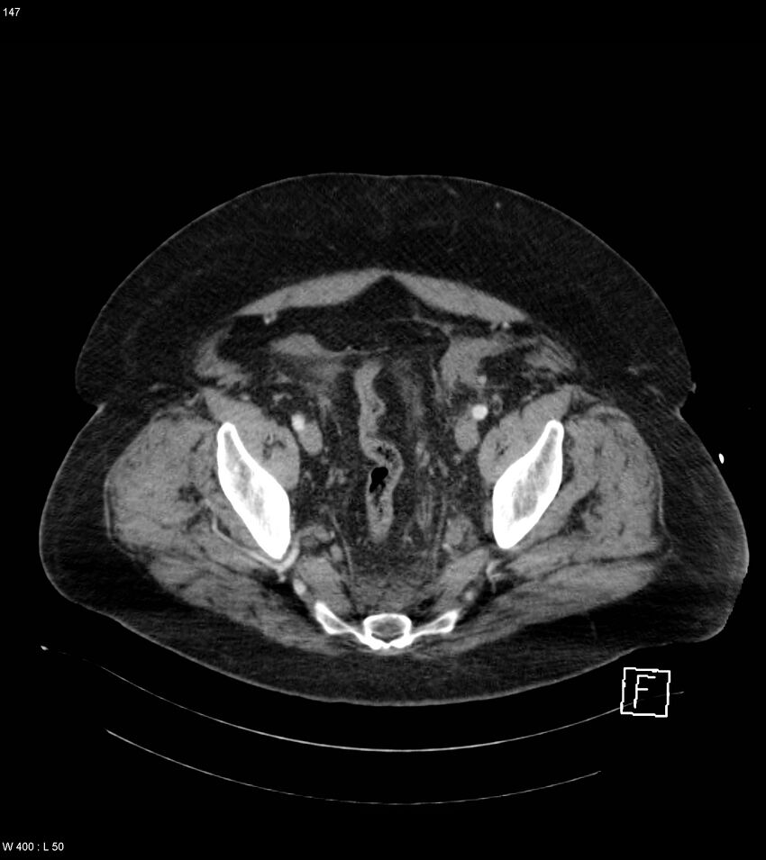 Abdominal aortic aneurysm with intramural hematoma then rupture (Radiopaedia 50278-55632 Axial C+ arterial phase 146).jpg