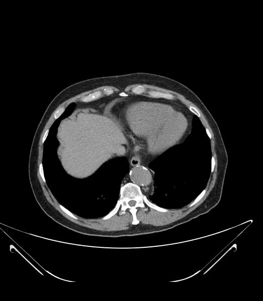 File:Abdominal aortic aneurysm with thrombus fissuration (Radiopaedia 46218-50618 Axial non-contrast 5).jpg
