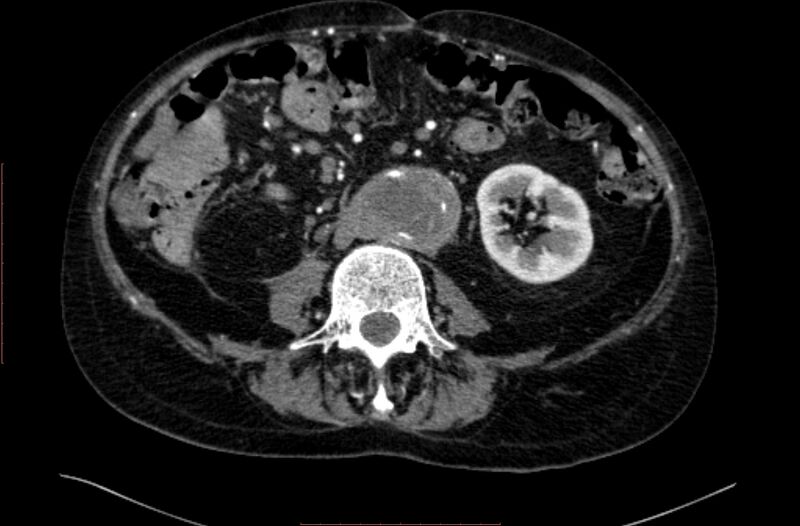 File:Abdominal aortic interposition tube graft and aneurysm thrombosis (Radiopaedia 71438-81857 Axial C+ arterial phase 95).jpg