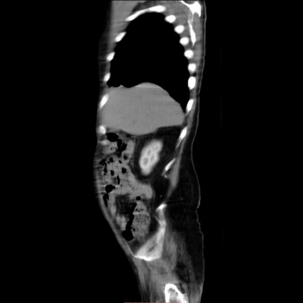 File:Abdominal aortic interposition tube graft and aneurysm thrombosis (Radiopaedia 71438-81857 Sagittal C+ arterial phase 29).jpg