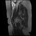 Abdominal wall endometriosis (Radiopaedia 83702-98847 Sagittal T2 fat sat 1).jpg