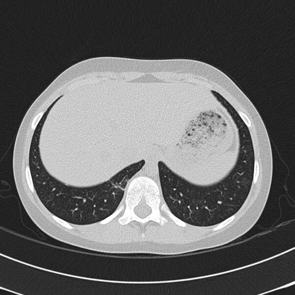 File:Achalasia (Radiopaedia 14946-14878 Axial lung window 72).jpg