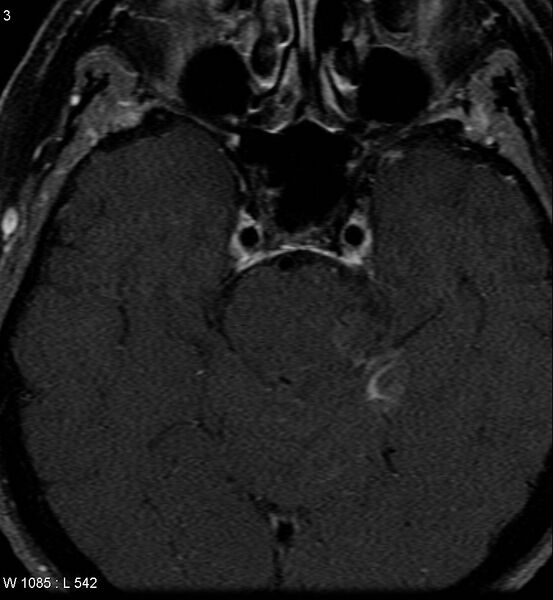 File:Acoustic schwannoma (large with cystic change) (Radiopaedia 5369-7130 Axial T1 C+ fat sat 1).jpg