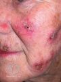 Actinic Keratoses treated with imiquimod (DermNet NZ lesions-ak-imiquimod-3762).jpg