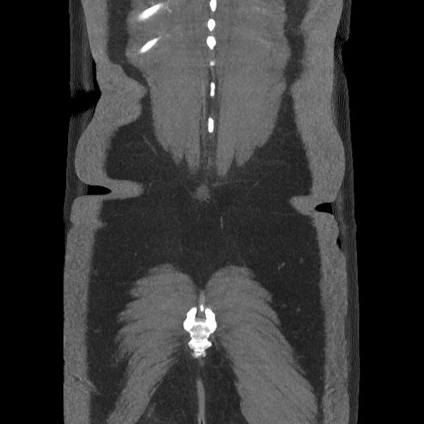 File:Active colonic bleed on CT (Radiopaedia 49765-55025 Coronal art MIP 58).jpg