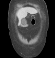 Acute acalculous cholecystitis (Radiopaedia 48250-53123 Coronal C+ portal venous phase 2).png