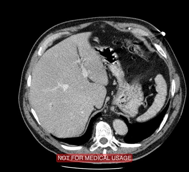File:Acute aortic dissection - Stanford type A (Radiopaedia 40661-43285 Axial C+ portal venous phase 62).jpg