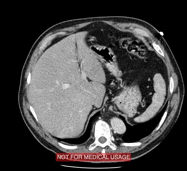 File:Acute aortic dissection - Stanford type A (Radiopaedia 40661-43285 Axial C+ portal venous phase 63).jpg