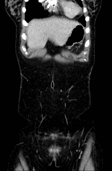 File:Acute appendicitis (Radiopaedia 22892-22918 Coronal C+ portal venous phase 4).png