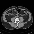 Acute appendicitis with appendicolith (Radiopaedia 6062).jpg
