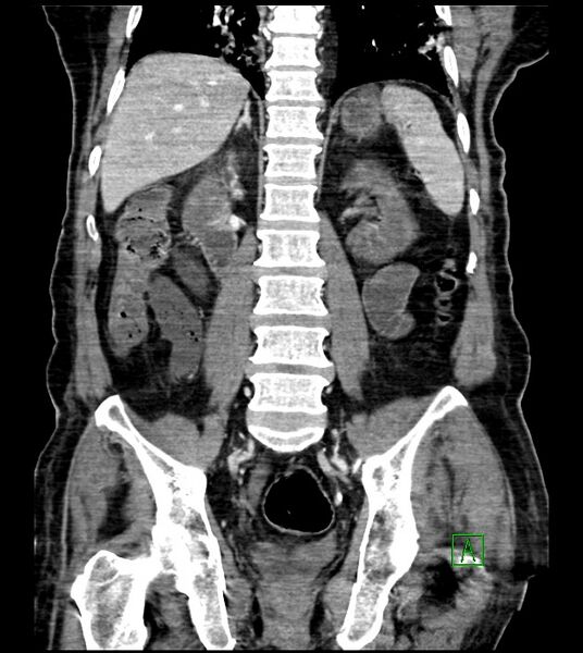 File:Acute arterial mesenteric ischemia (Radiopaedia 78238-90828 Coronal C+ portal venous phase 61).jpg
