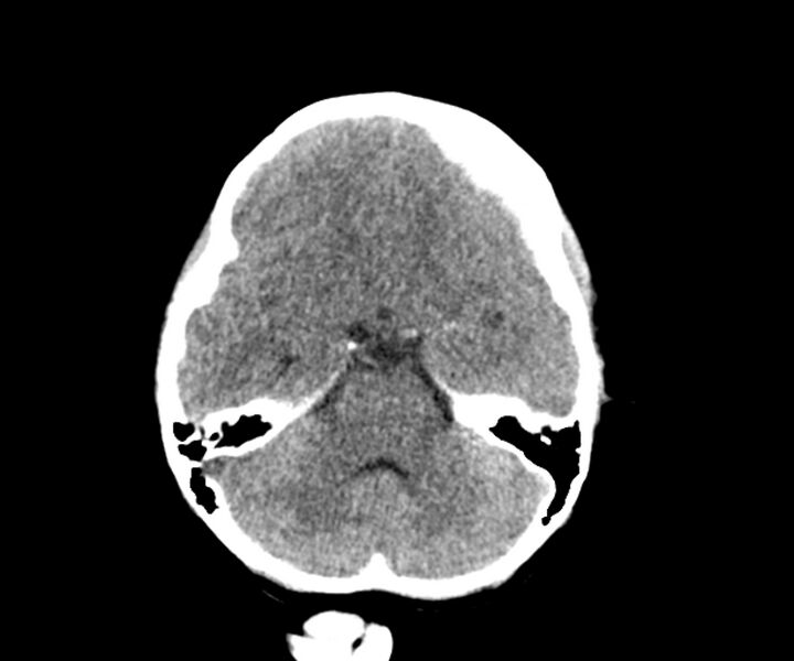 File:Acute epidural hematoma (Radiopaedia 63659-72335 Axial non-contrast 4).jpg