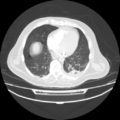 Acute heart failure (CT) (Radiopaedia 79835-93075 Axial lung window 32).png