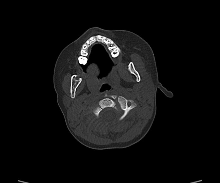 File:Acute hemorrhagic contusion (Radiopaedia 63660-72336 Axial bone window 4).jpg