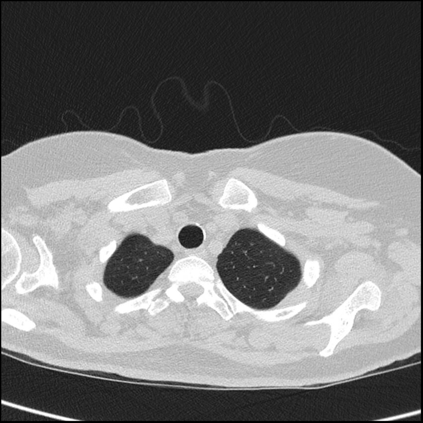 Acute interstitial pneumonitis (Radiopaedia 45404-49453 Axial lung window 10).jpg