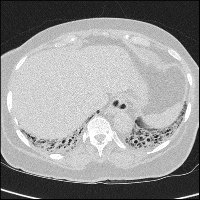 Acute interstitial pneumonitis (Radiopaedia 45404-49453 Axial lung window 67).jpg