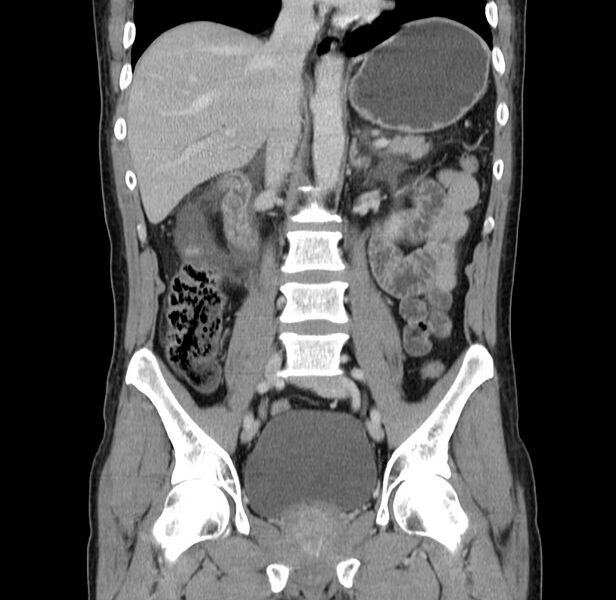 File:Acute pancreatitis (Radiopaedia 22572-22596 Coronal C+ portal venous phase 30).jpg