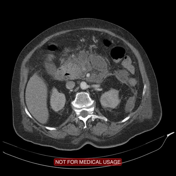 File:Acute pancreatitis with infected necrosis (Radiopaedia 26454-26585 Axial C+ arterial phase 12).jpg