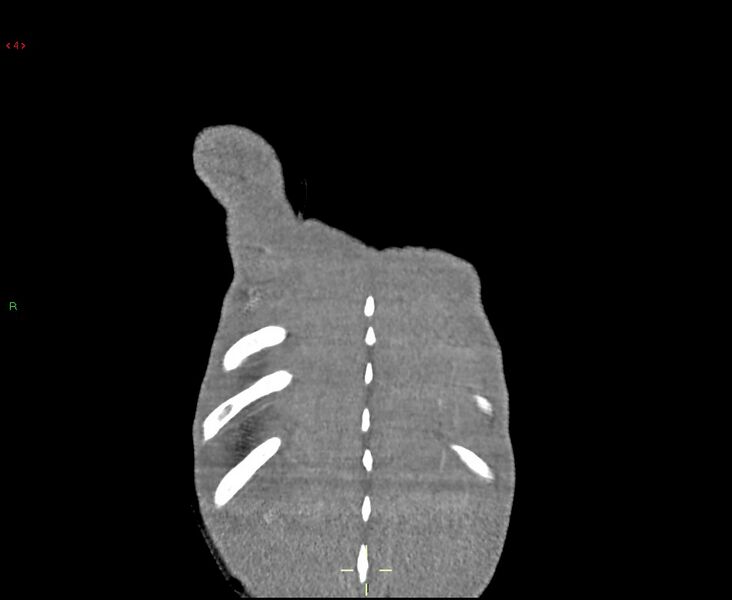 File:Acute right lung abscess (Radiopaedia 34806-36258 Coronal C+ arterial phase 55).jpg