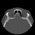 Acute sinusitis (Radiopaedia 23161-23215 Axial bone window 60).jpg