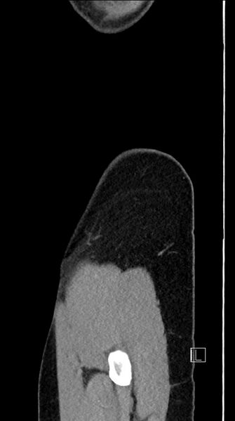 File:Acute uncomplicated appendicitis (Radiopaedia 61374-69304 Sagittal C+ portal venous phase 2).jpg