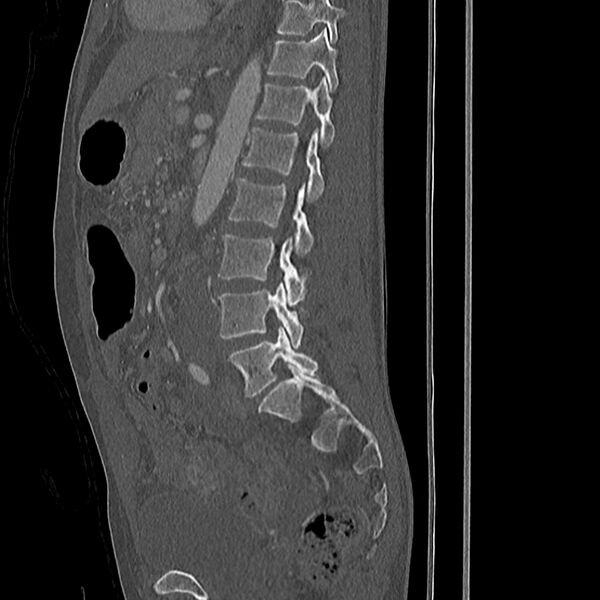 File:Acute vertebral body compression fractures (Radiopaedia 31757-32693 Sagittal bone window 19).jpg