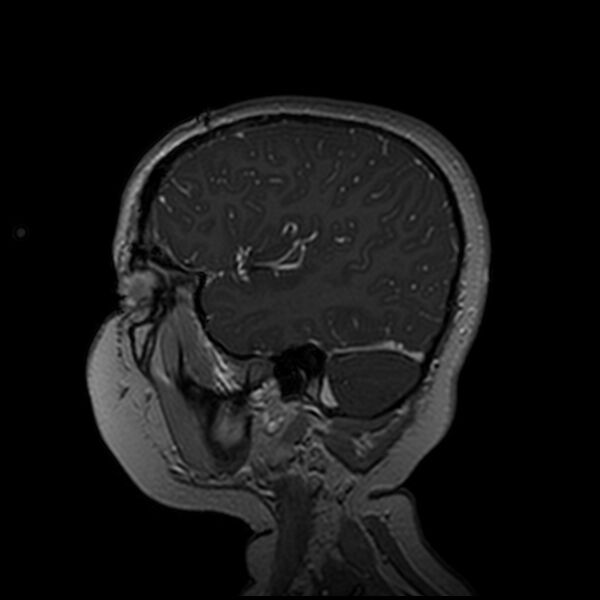 File:Adamantinomatous craniopharyngioma (Radiopaedia 77407-89529 H 95).jpg