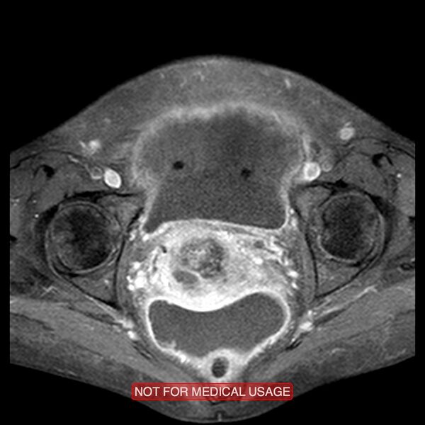 File:Adenocarcinoma of the cervix (Radiopaedia 28373-28615 Axial T1 C+ fat sat 8).jpg