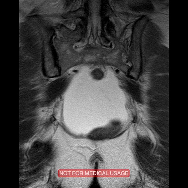 File:Adenocarcinoma of the cervix (Radiopaedia 28373-28615 Coronal T2 17).jpg