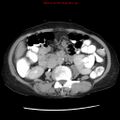 Adenocarcinoma of the colon (Radiopaedia 8191-9039 Axial renal excretory phase 22).jpg