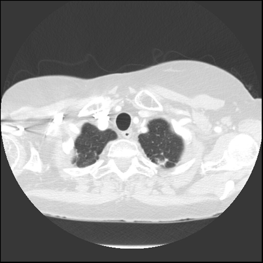 Adenocarcinoma of the lung (Radiopaedia 41015-43755 Axial lung window 12).jpg