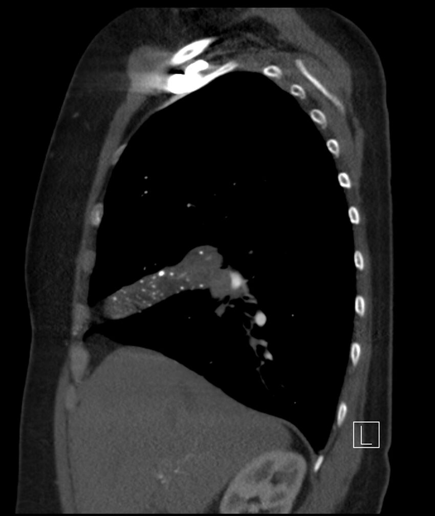 Adenocarcinoma of the lung (Radiopaedia 44205-47803 Sagittal C+ portal venous phase 39).jpg